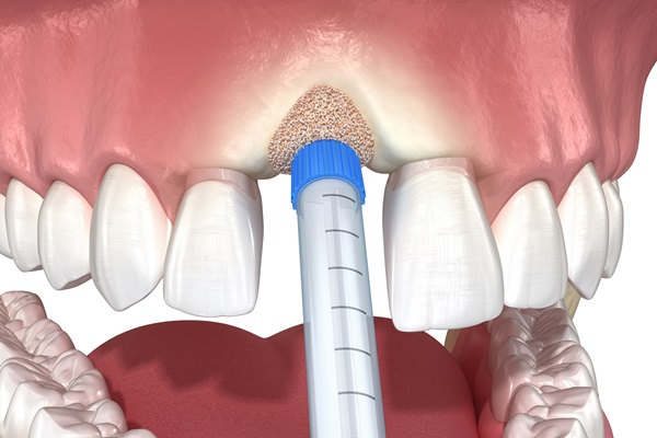 How Does A Dentist Know When A Bone Graft Is Necessary?